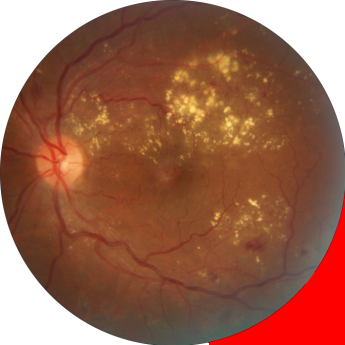 La primera causa de ceguera en México por Retina Center Tijuana