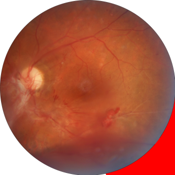 La primera causa de ceguera en México por Retina Center Tijuana