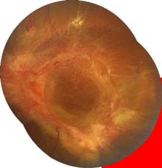 La primera causa de ceguera en México por Retina Center Tijuana