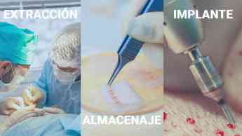 Hombres padecen un 63% más de pérdida de cabello, el injerto capilar la mejor opción según especialistas