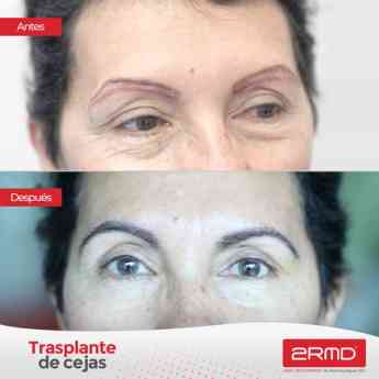 Trasplante de cejas y pestañas: recomendaciones de 2RMD expertos en trasplante capilar